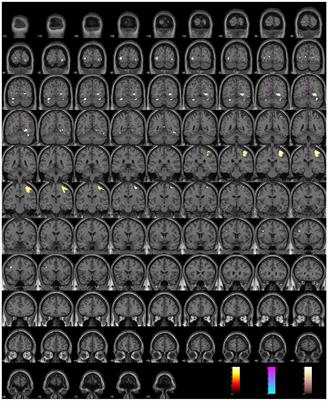 Perspectives before incremental trans-disciplinary cross-validation of clinical self-evaluation tools and functional MRI in psychiatry: 10 years later